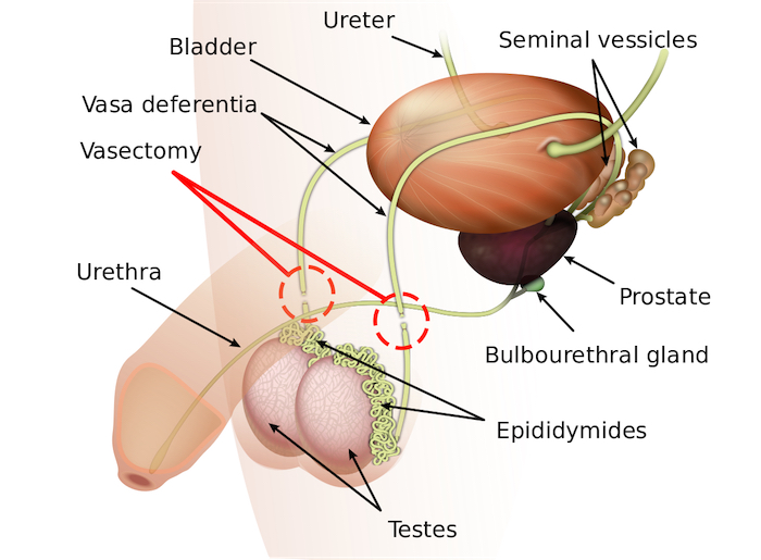 one-man-s-story-i-took-a-mulligan-on-my-vasectomy-and-got-my-third